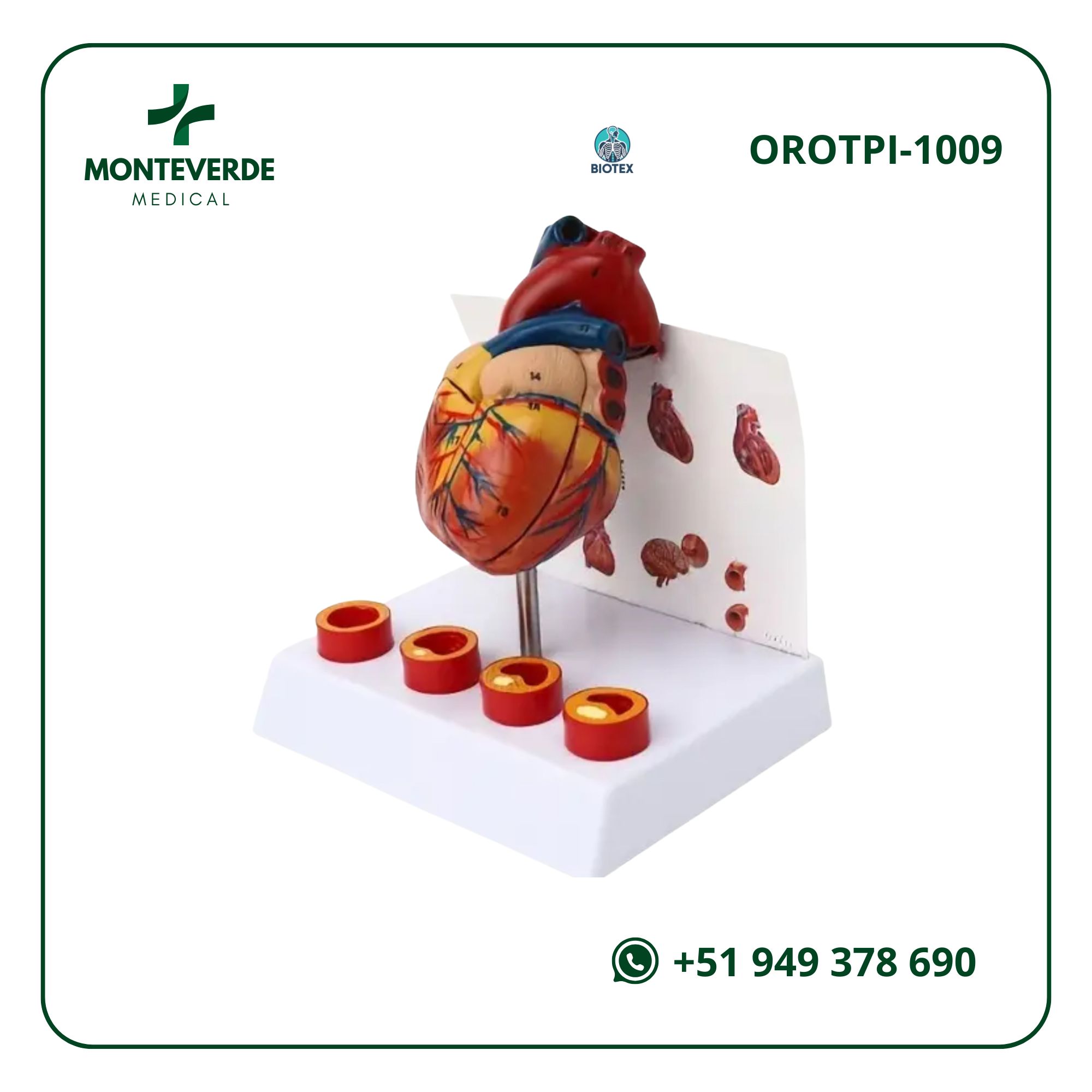 Maqueta del Corazón Humano con Trombos en 4 Etapas