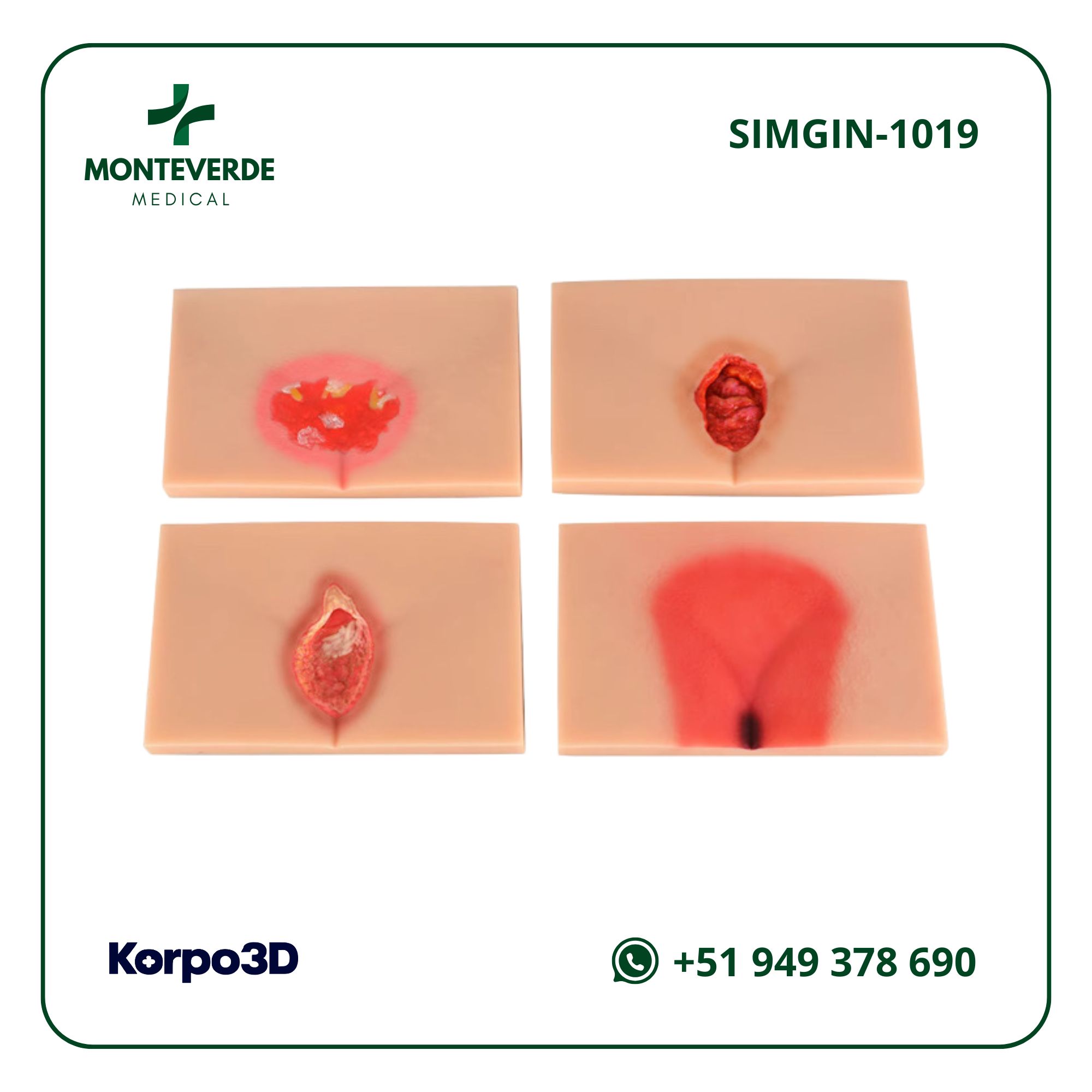 Modelo de 4 ETAPAS DE ÚLCERAS POR PRESIÓN