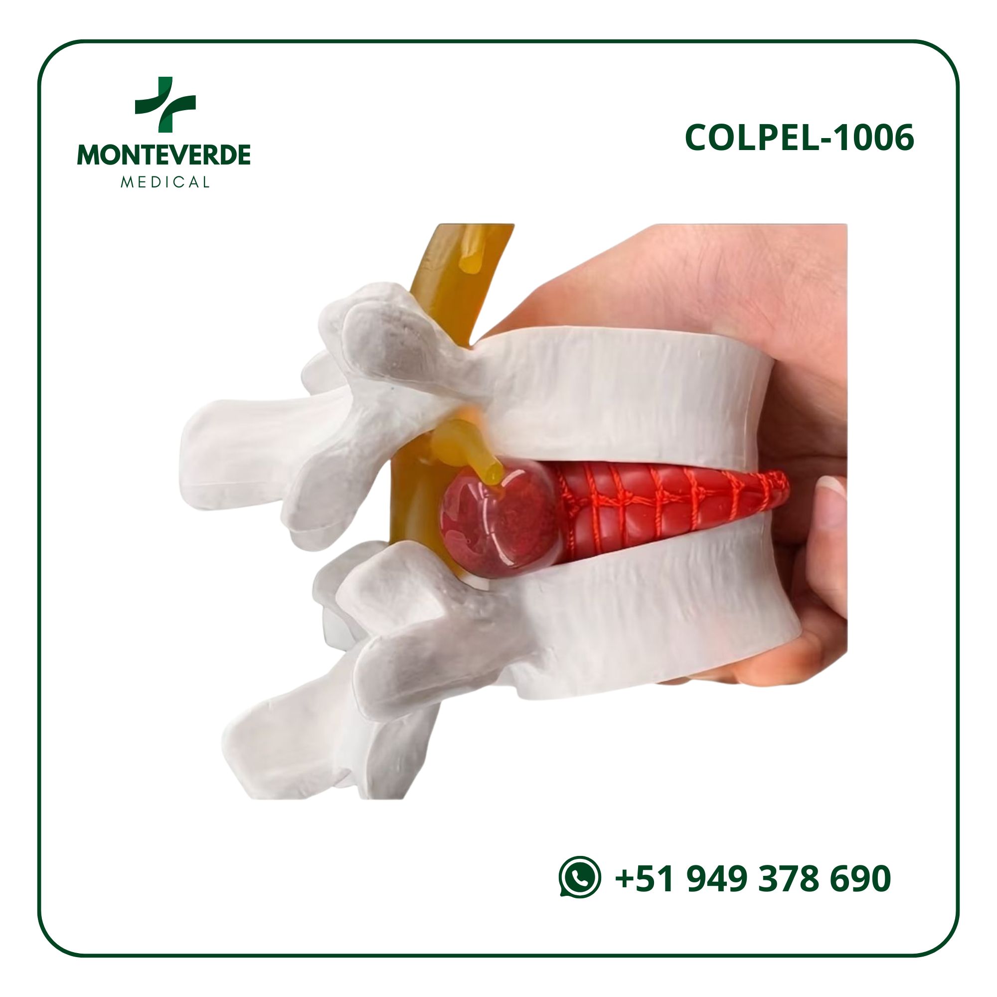 maqueta de hernia discal lumbar